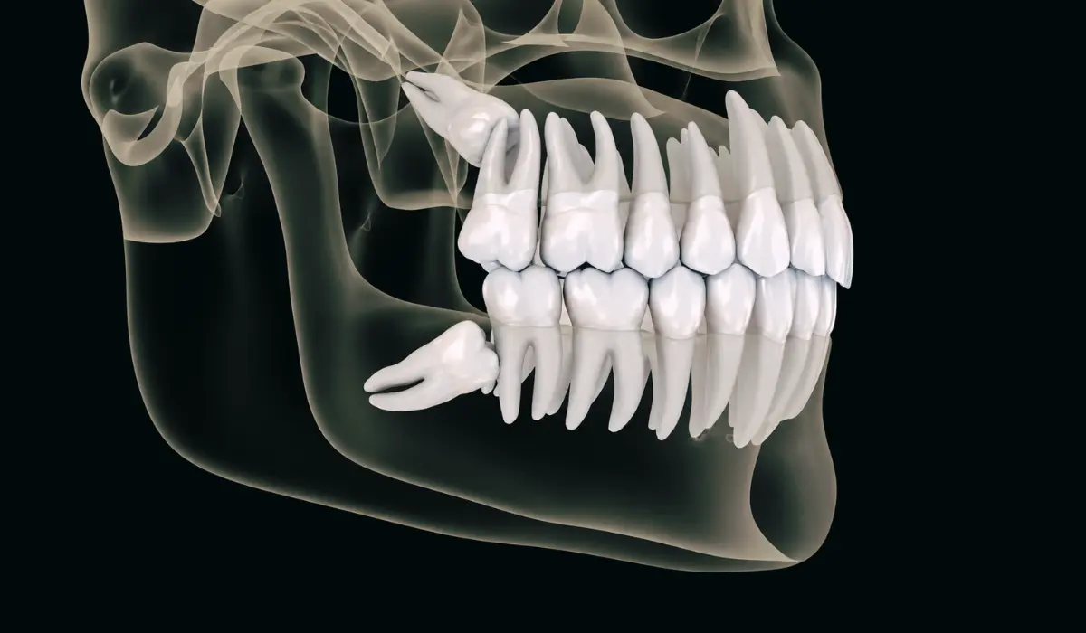 wisdom tooth pain symptoms